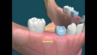 Dental Video of Early Loss of primary Teeth