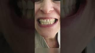 Zirconium Veneers - Dr. Serhan Aktan