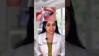 Have crooked teeth and don't have time to correct them?