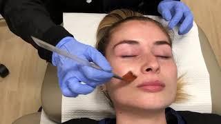 Chemical Peel Treatment | La Jolla Cosmetic Laser Clinic