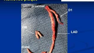 Coronary Endarterectomy of the Left Anterior Descending Artery