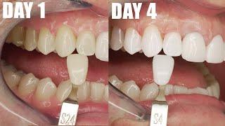 SUPER WHITE TEETH in 4 DAYS At Home! Dentist Shows Daily Results Better  Than a Dentist Office.