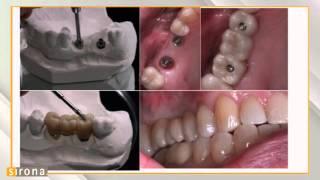 No Limits: The Variety of Implant Possibilities with inLab SW 15