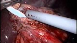 Band Erosion: Laparoscopic Lap-Band Removal