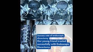 The success rate of Endoscopic Discectomy. Spine Surgery best treatment in Delhi.