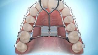 Hyrax Rapid Palatal Expansion Braces During