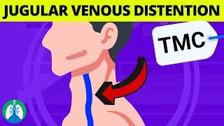 What are the Causes of Jugular Venous Distention (JVD)? | TMC Practice Question