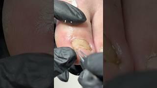 Minor Ingrown Nail Fixed Without Surgery! #ingrowntoenail