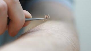 How to properly remove a tick