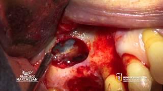 SINUS LIFT AT THE RIGHT MAXILLA.