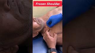 Needles & Healing: A Deep Dive into Frozen Shoulder Dry Needling @PT.Anindya
