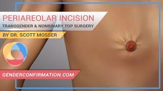 Periareolar Transgender & Non-binary Top Surgery by Dr. Scott Mosser