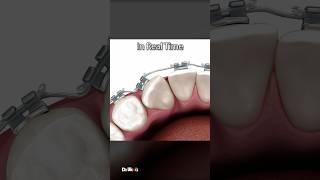 Cuspid Correction In Real Time: ASMR