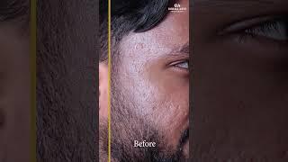 Hydra Facial Treatment Before and After | Dr. Mitra Amiri #dermaarts #drmitraamiri
