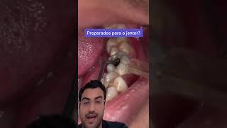 DENTISTA reage a JANTAR DENTRO DO DENTE!