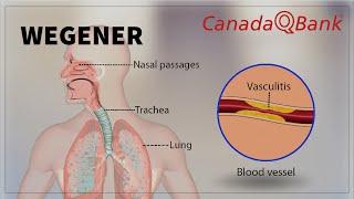 Wegener Granulomatosis