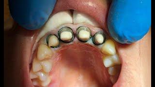 Лечение периодонтита восстановление вкладками циркониевыми коронками клинический кейс вторичное эндо