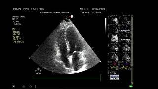 Эхокардиография (направлен терапевтом , г. Уссурийск, клиника Возрождение)