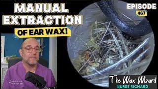 MANUAL EXTRACTION OF EAR WAX!  Episode 467 (& menopausal ear wax?)