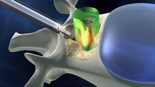 IBS Hospital | Minimally Invasive Spine Surgery | Effective Treatment with Faster Recovery