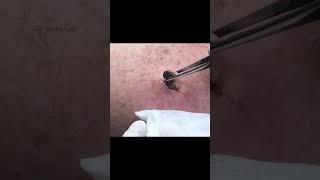 Blackhead New Years Pop!