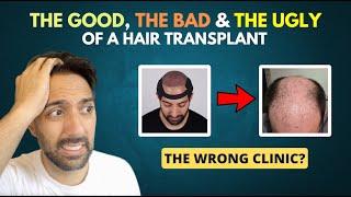 The Good, The Bad & The Ugly of a Hair Transplant