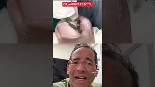 MAMMOTH INGROWN TOENAIL REMOVAL  #shorts #ingrown #ingrowntoenail