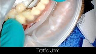 Supernumerary Tooth Causing a Traffic Jam. Step by Step Dental Extraction