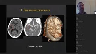 КТ острых ишемических инфарктов