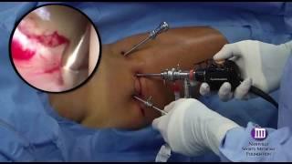 How to Perform Hip Arthroscopy | Portal Placement | Nashville Hip Institute