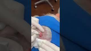 Here you go - a pilar cyst extraction straight from the scalp!⁠⁠