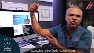 Armlift in Tijuana Mexico - Dr. Manuel Gutierrez - Best Plastic Surgeon