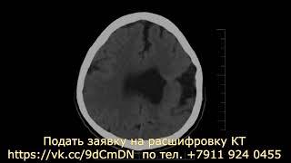 Дисциркуляторная энцефалопатия на расшифровке КТ мозга с диска в формате DICOM