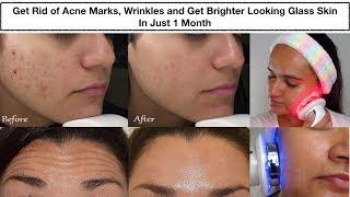 Get Rid of Acne Marks & Wrinkles & Get Glass Skin In Just 1 Month || Ultrasonic Photon Therapy