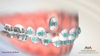 Orthodontic Treatment for Impacted Canine - Laser Exposure