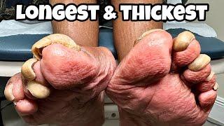 LONGEST & THICKEST TOENAILS EVER! 