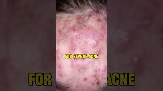Guide for finding the right cleanser for acne prone skin