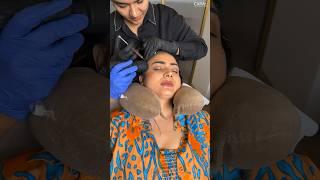 Hair prp treatment session for hair thinning | hair loss solution