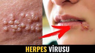 HERPES VİRUSU - Simptomları, Yaranma səbəbi