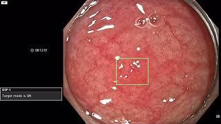 Diminutive Adenoma Detection with AI - Olympus ENDOAID Target Mode and NBI