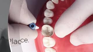 Palodent 360 Comparison Video No Sound