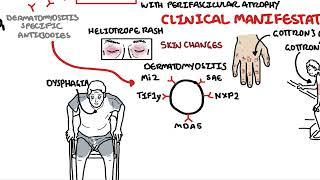 Dermatomyositis Overview