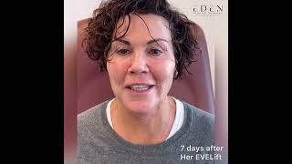 EVELift Facelift Patient Testimonial | Dr. Ali Charafeddine Eden Plastic Surgery Miami FL