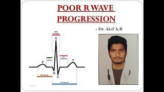 POOR R WAVE PROGRESSION -ECG