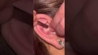 Cuando tu amiga te extrae el punto negro de la oreja y hace un desastre #blackhead #ear #puntonegro