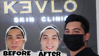 KEVLO SKIN CLINIC ORMOC | THE BEST SKIN CLINIC | BEST FACIAL IN ORMOC