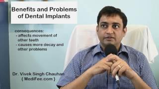 Dental Implants - Benefits and Problems