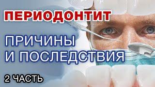 ПРИЧИНЫ периодонтита / Последствия периодонтита Часть 2