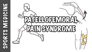 Patellofemoral Pain Syndrome - runner's knee