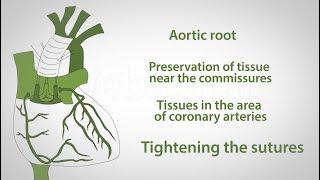 David operation (aortiv valve reconstruktion)